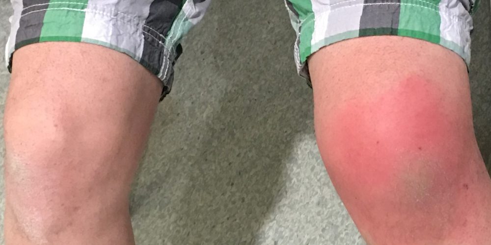 bursitis in knee symptoms causes and treatment