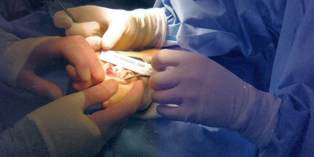 plantar fasciitis surgery options