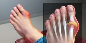 what is gout symptoms causes treatment