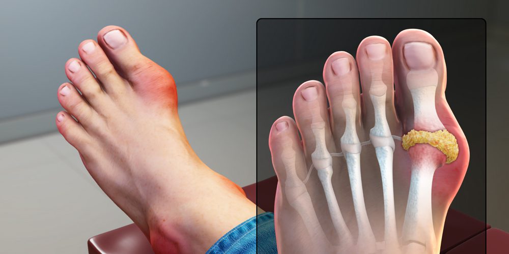 what is gout symptoms causes treatment