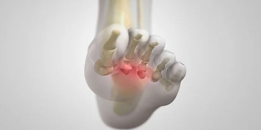 Norton's neuroma symptoms diagnosis causes treatment and prevention