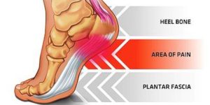 plantar fasciosis symtoms causes disgnosis treatment home remedies