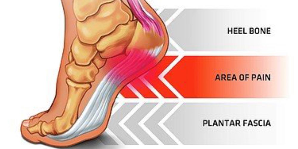 plantar fasciosis symtoms causes disgnosis treatment home remedies