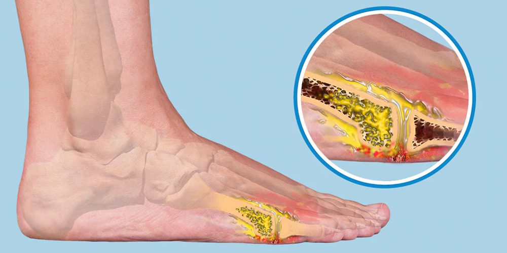 osteomyelitis causes symptoms treatment surgery prevention and how it affects your life