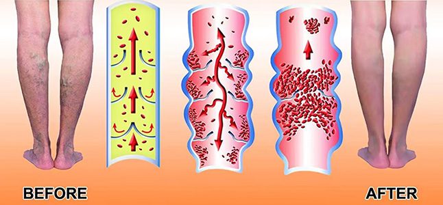 plus size compression socks before after benefits