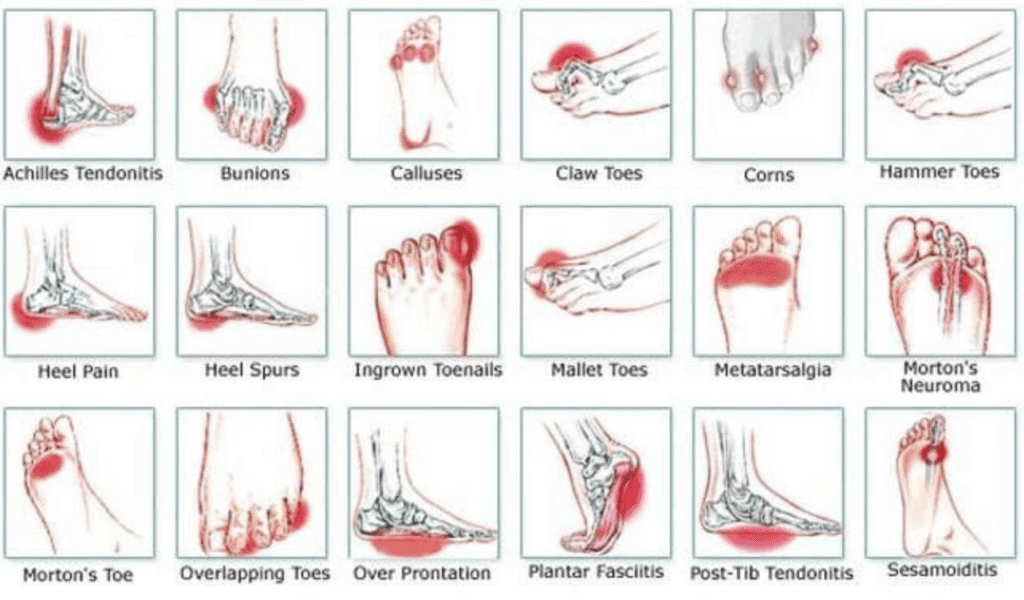 foot pain diagram chart